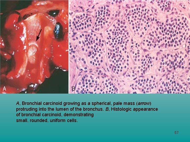 A, Bronchial carcinoid growing as a spherical, pale mass (arrow) protruding into the lumen