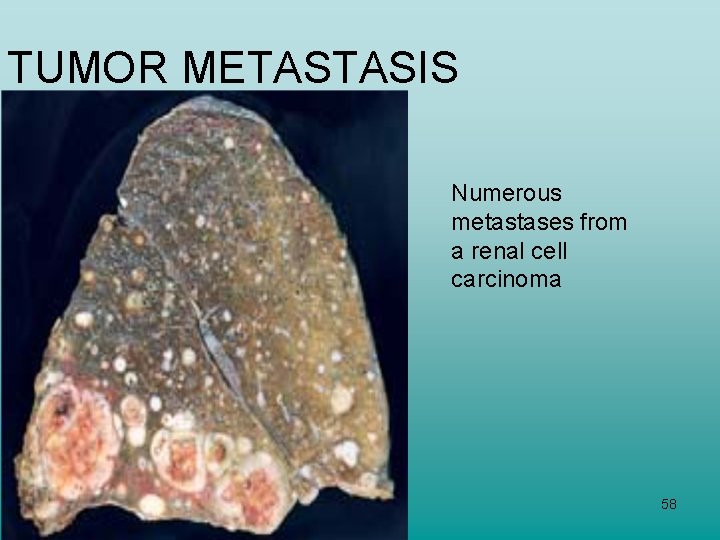 TUMOR METASTASIS Numerous metastases from a renal cell carcinoma 58 