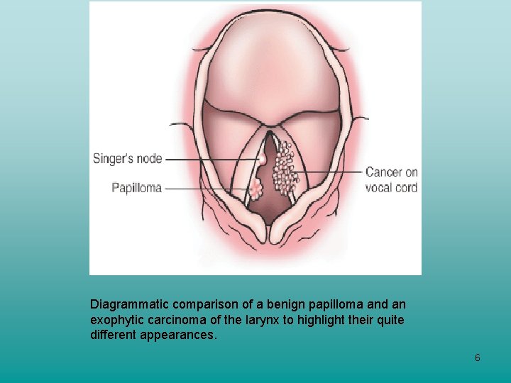 Diagrammatic comparison of a benign papilloma and an exophytic carcinoma of the larynx to