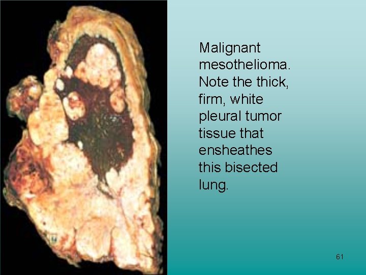 Malignant mesothelioma. Note thick, firm, white pleural tumor tissue that ensheathes this bisected lung.