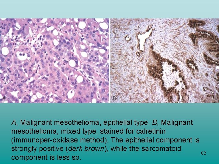 A, Malignant mesothelioma, epithelial type. B, Malignant mesothelioma, mixed type, stained for calretinin (immunoper-oxidase