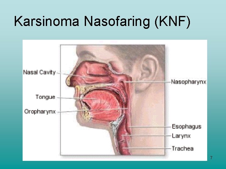 Karsinoma Nasofaring (KNF) 7 