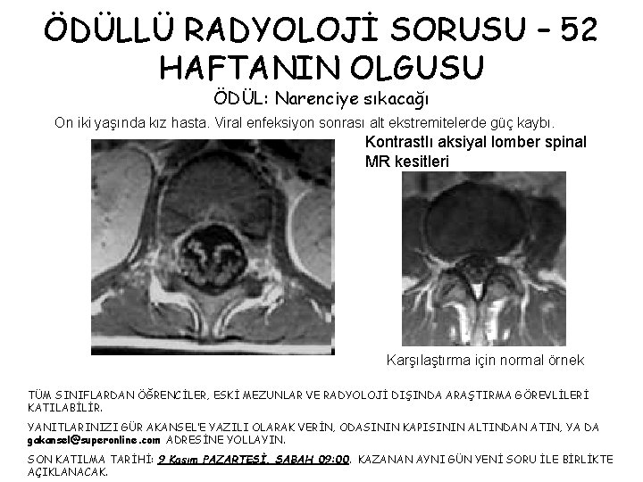 ÖDÜLLÜ RADYOLOJİ SORUSU – 52 HAFTANIN OLGUSU ÖDÜL: Narenciye sıkacağı On iki yaşında kız