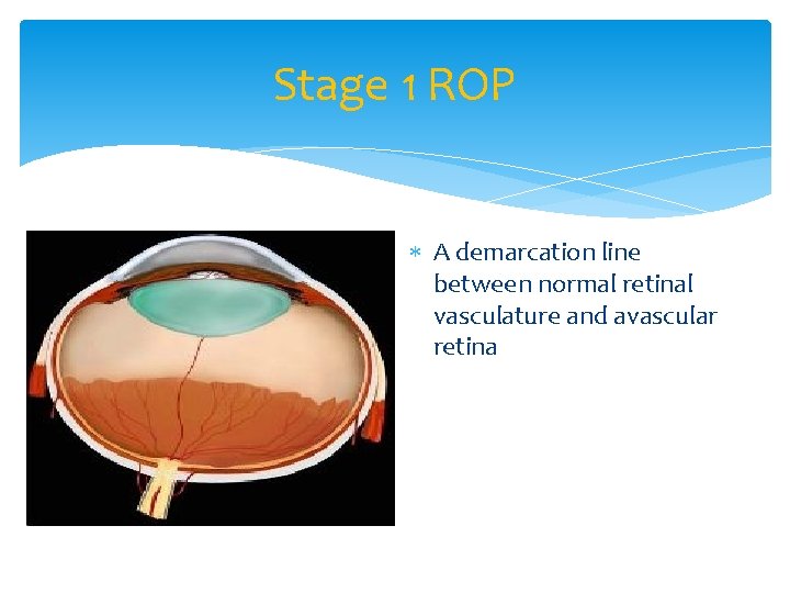 Stage 1 ROP A demarcation line between normal retinal vasculature and avascular retina 