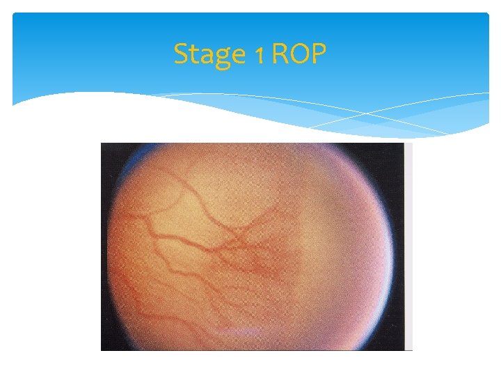 Stage 1 ROP 