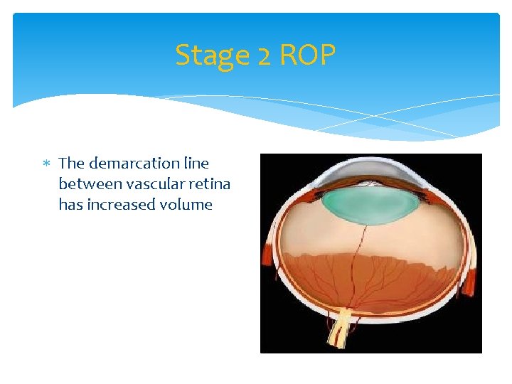 Stage 2 ROP The demarcation line between vascular retina has increased volume 