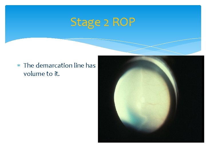 Stage 2 ROP The demarcation line has volume to it. 