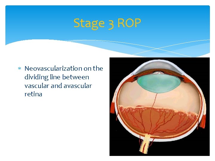 Stage 3 ROP Neovascularization on the dividing line between vascular and avascular retina 