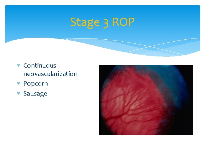 Stage 3 ROP Continuous neovascularization Popcorn Sausage 