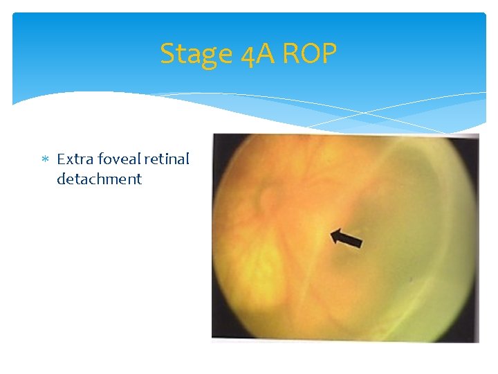 Stage 4 A ROP Extra foveal retinal detachment 