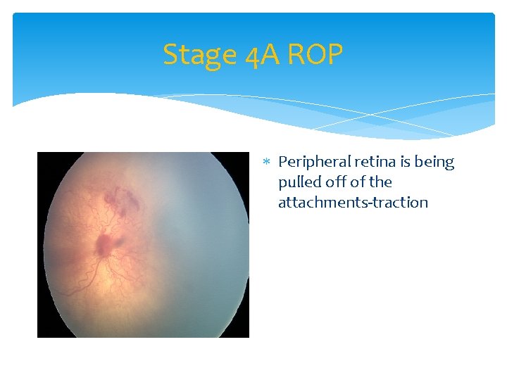 Stage 4 A ROP Peripheral retina is being pulled off of the attachments-traction 