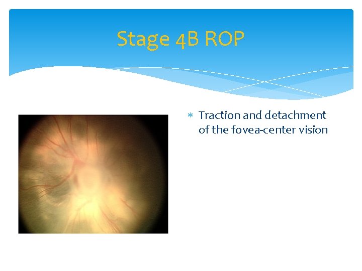 Stage 4 B ROP Traction and detachment of the fovea-center vision 