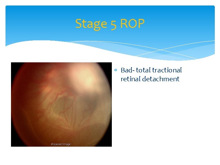 Stage 5 ROP Bad- total tractional retinal detachment 