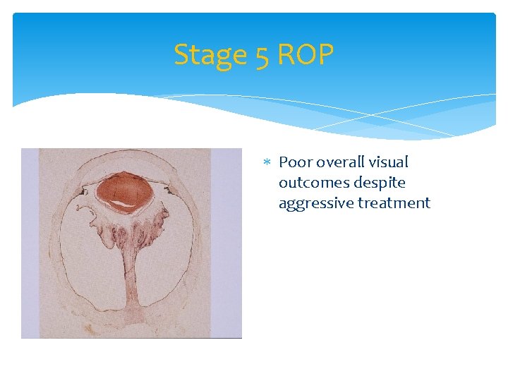 Stage 5 ROP Poor overall visual outcomes despite aggressive treatment 