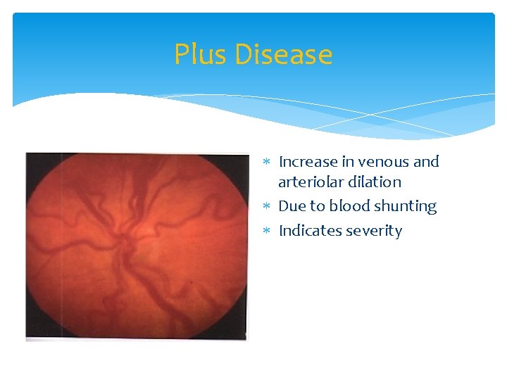 Plus Disease Increase in venous and arteriolar dilation Due to blood shunting Indicates severity