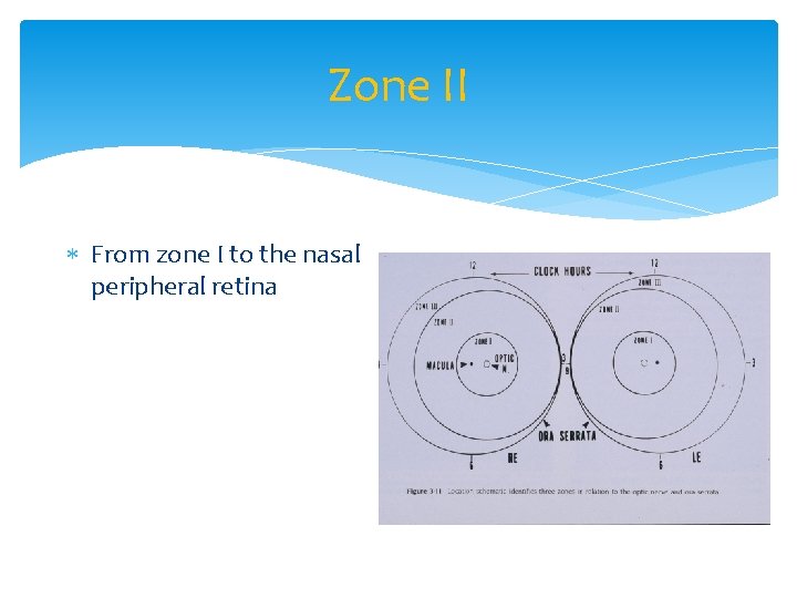 Zone II From zone I to the nasal peripheral retina 
