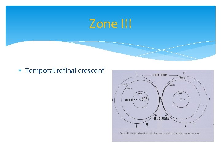 Zone III Temporal retinal crescent 