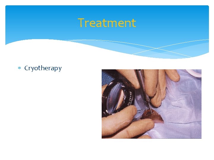 Treatment Cryotherapy 