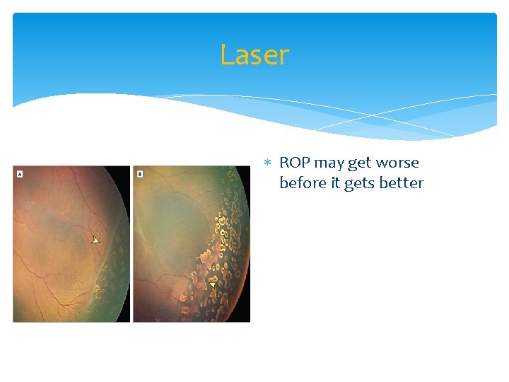 Laser ROP may get worse before it gets better 