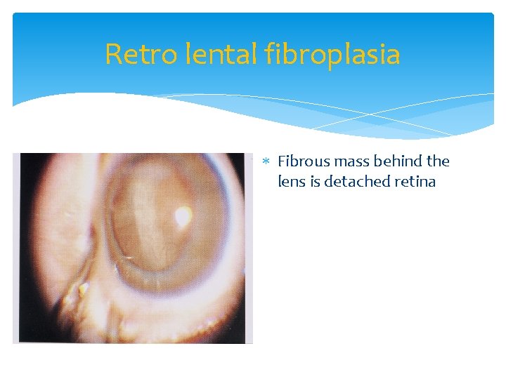 Retro lental fibroplasia Fibrous mass behind the lens is detached retina 