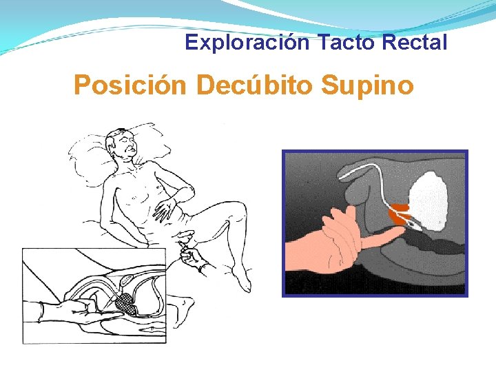 Exploración Tacto Rectal Posición Decúbito Supino Exploración Tacto Rectal Posición Decúbito Supino