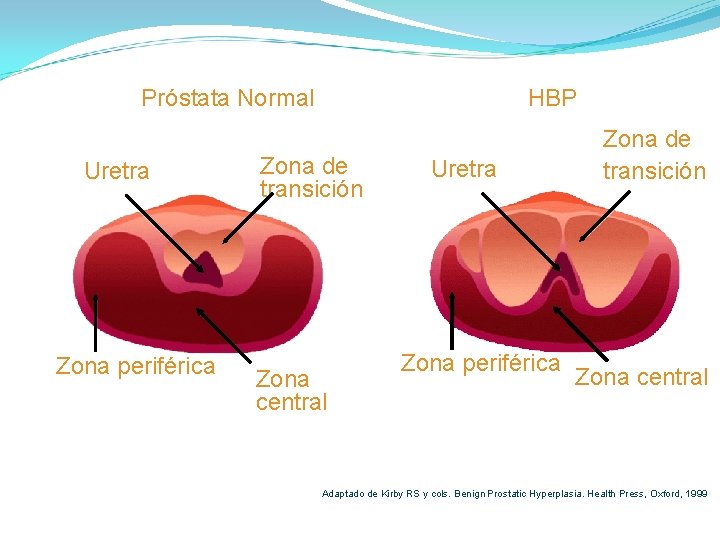 Próstata Normal Uretra Zona periférica HBP Zona de transición Zona central Uretra Zona periférica Próstata Normal Uretra Zona periférica HBP Zona de transición Zona central Uretra Zona periférica