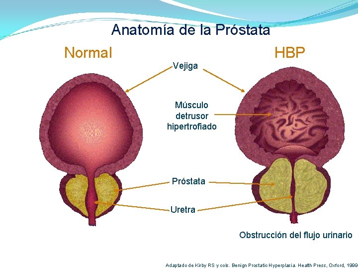 Anatomía de la Próstata Normal Vejiga HBP Músculo detrusor hipertrofiado Próstata Uretra Obstrucción del Anatomía de la Próstata Normal Vejiga HBP Músculo detrusor hipertrofiado Próstata Uretra Obstrucción del