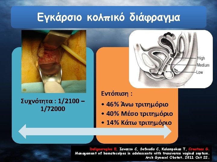 Εγκάρσιο κολπικό διάφραγμα Συχνότητα : 1/2100 – 1/72000 Εντόπιση : • 46% Άνω τριτημόριο