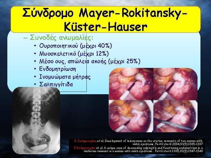 Σύνδρομο Mayer-Rokitansky. Küster-Hauser – Συνοδές ανωμαλίες: • • • Ουροποιητικού (μέχρι 40%) Μυοσκελετικό (μέχρι