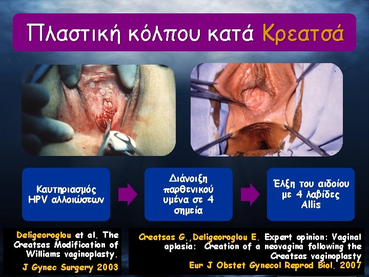 Πλαστική κόλπου κατά Κρεατσά Καυτηριασμός HPV αλλοιώσεων Deligeoroglou et al. The Creatsas Modification of