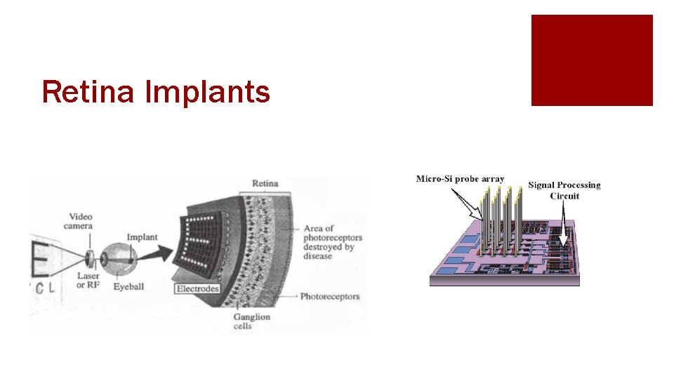 Retina Implants 