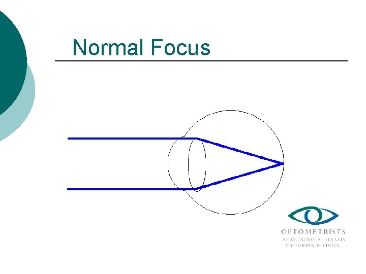 Normal Focus 