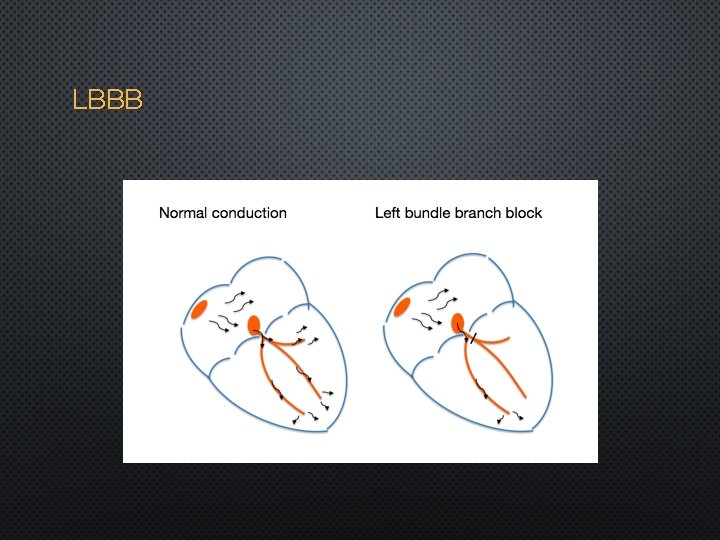 LBBB 