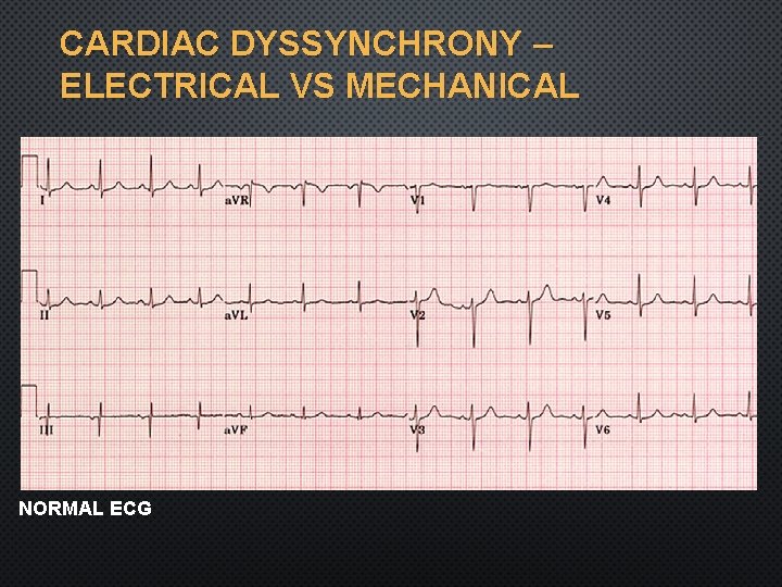 CARDIAC DYSSYNCHRONY – ELECTRICAL VS MECHANICAL DEVICE THERAPY IN HEART FAILURE “ SOMEONE WITH