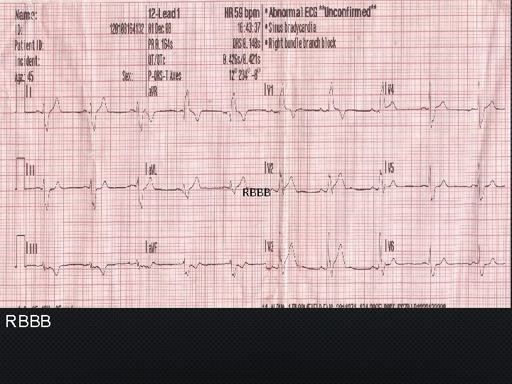 RBBB 