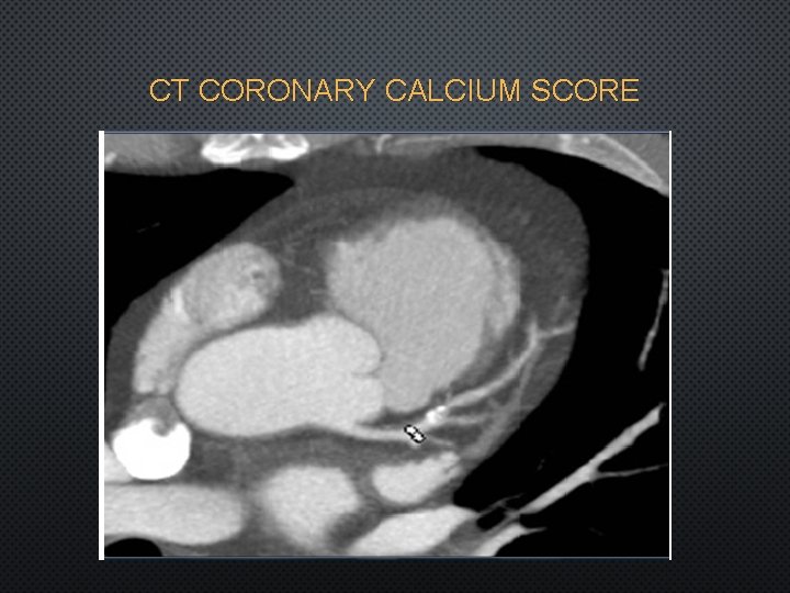 CT CORONARY CALCIUM SCORE 