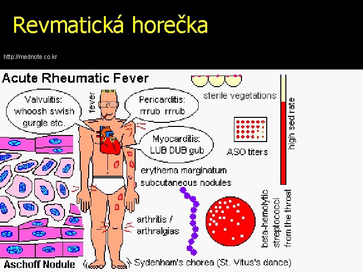 revmatická horečka unde este durerea articulației șoldului