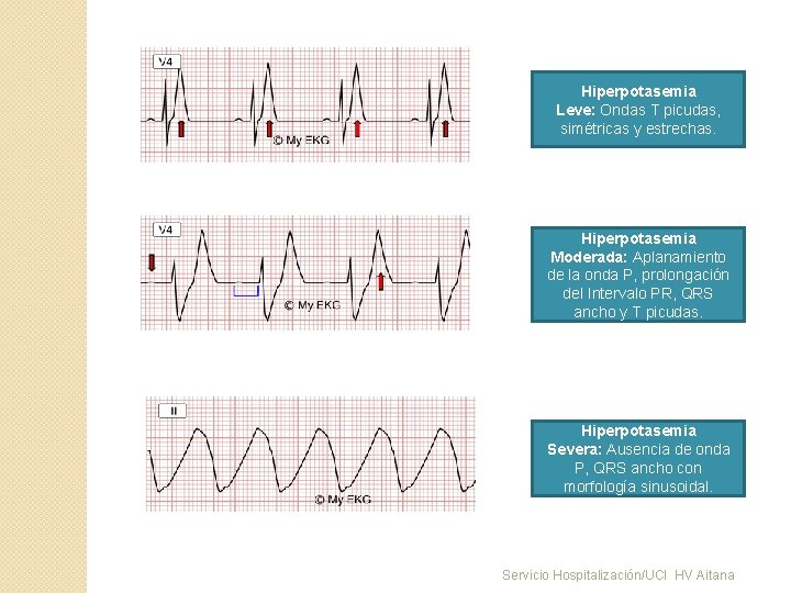 Hiperpotasemia Leve: Ondas T picudas, simétricas y estrechas. Hiperpotasemia Moderada: Aplanamiento de la onda