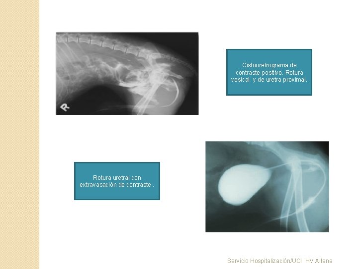 Cistouretrograma de contraste positivo. Rotura vesical y de uretra proximal. Rotura uretral con extravasación