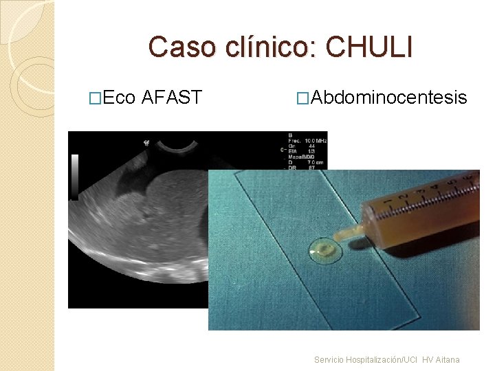 Caso clínico: CHULI �Eco AFAST �Abdominocentesis Servicio Hospitalización/UCI HV Aitana 