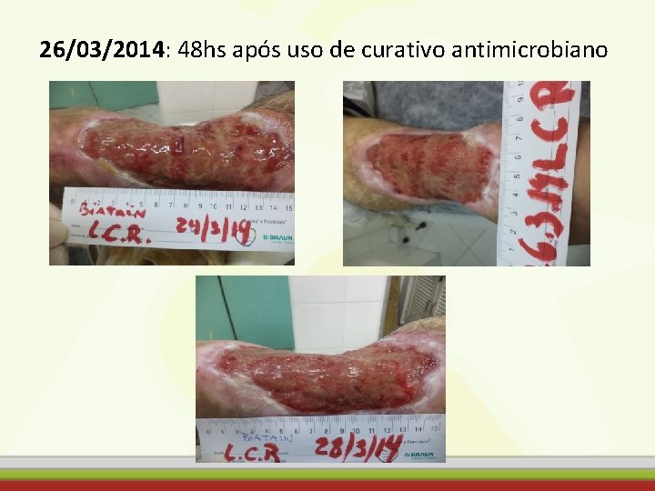 26/03/2014: 48 hs após uso de curativo antimicrobiano 