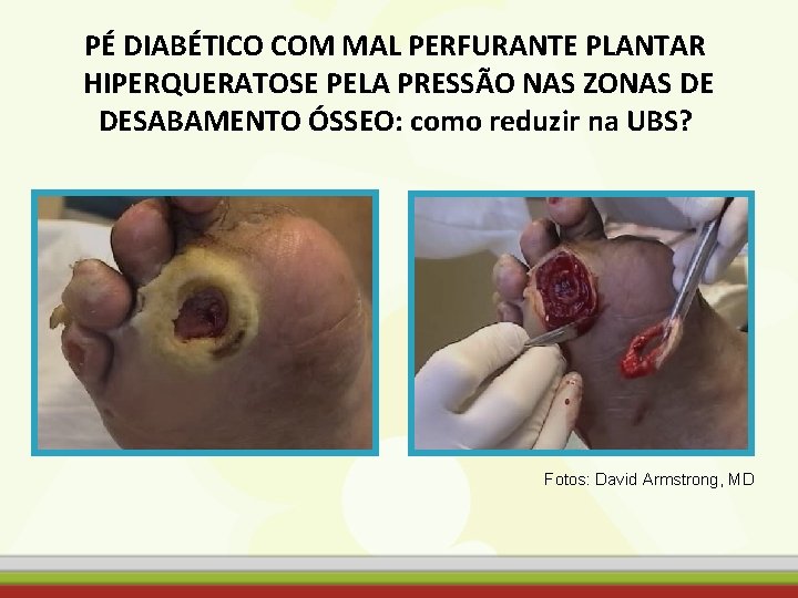 PÉ DIABÉTICO COM MAL PERFURANTE PLANTAR HIPERQUERATOSE PELA PRESSÃO NAS ZONAS DE DESABAMENTO ÓSSEO: