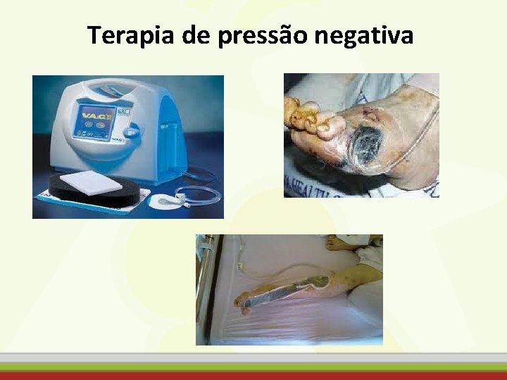 Terapia de pressão negativa 