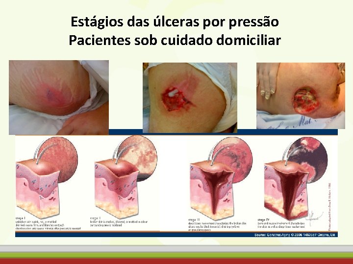 Estágios das úlceras por pressão Pacientes sob cuidado domiciliar 