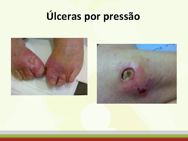 Úlceras por pressão 