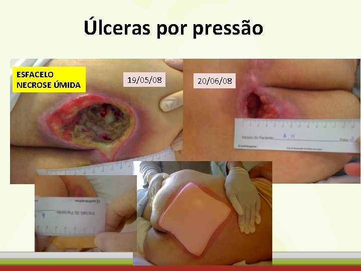 Úlceras por pressão ESFACELO NECROSE ÚMIDA 19/05/08 20/06/08 
