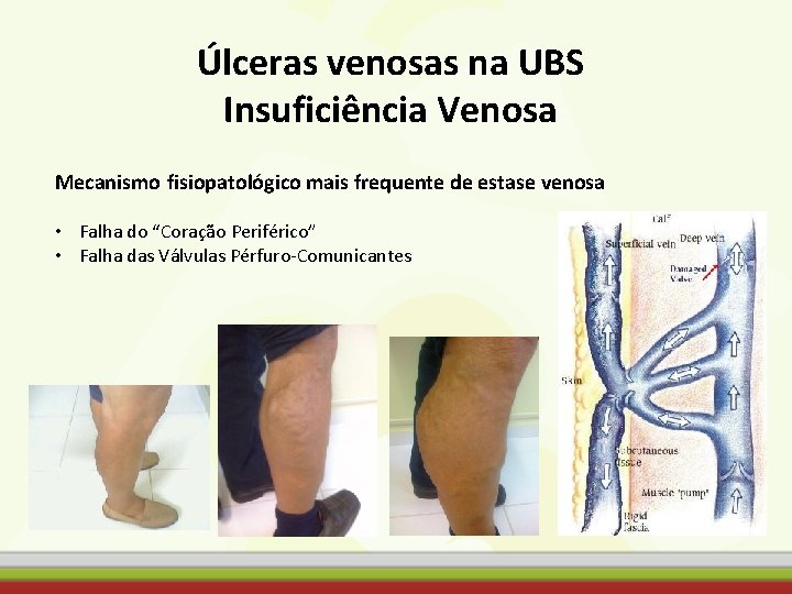 Úlceras venosas na UBS Insuficiência Venosa Mecanismo fisiopatológico mais frequente de estase venosa •