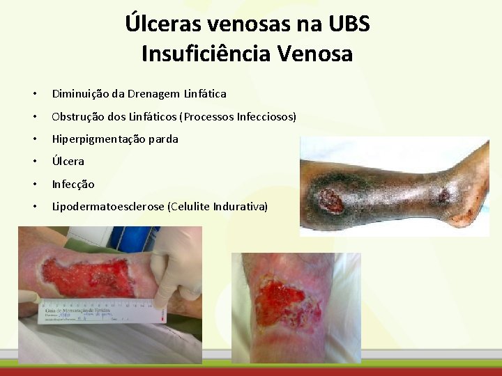 Úlceras venosas na UBS Insuficiência Venosa • Diminuição da Drenagem Linfática • Obstrução dos