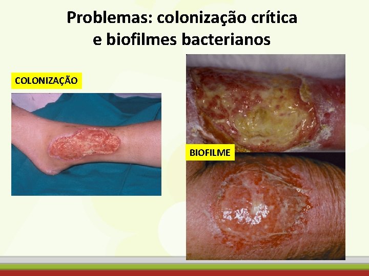 Problemas: colonização crítica e biofilmes bacterianos COLONIZAÇÃO BIOFILME 