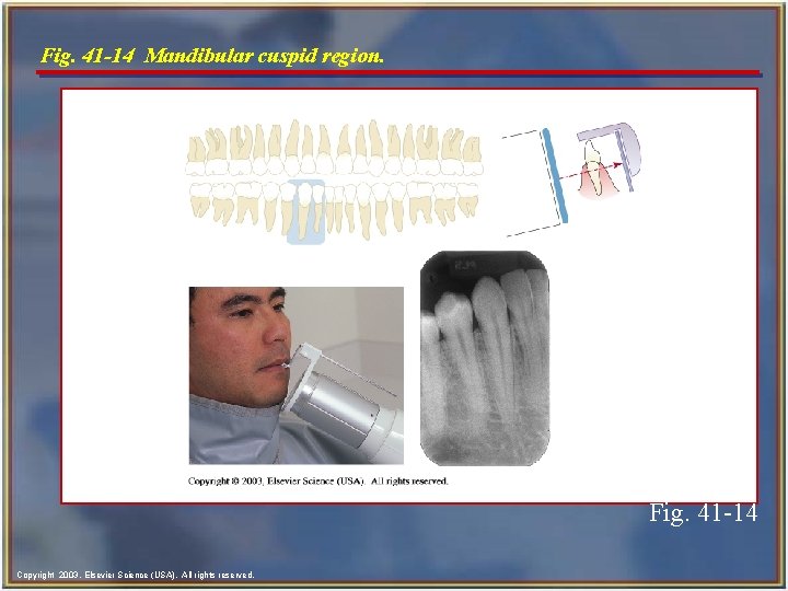 Fig. 41 -14 Mandibular cuspid region. Fig. 41 -14 Copyright 2003, Elsevier Science (USA).